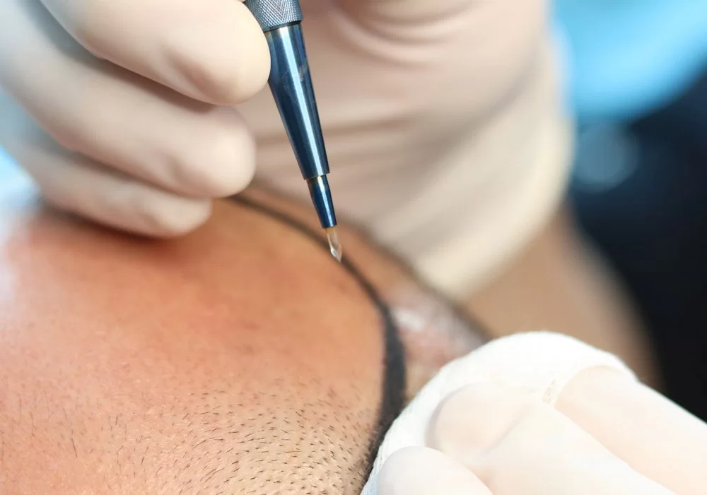 Sapphire Hair Transplant