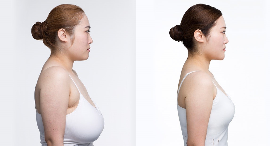 What is Breast Surgery ?