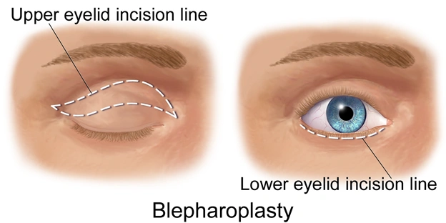 Enhance Your Look with Blepharoplasty