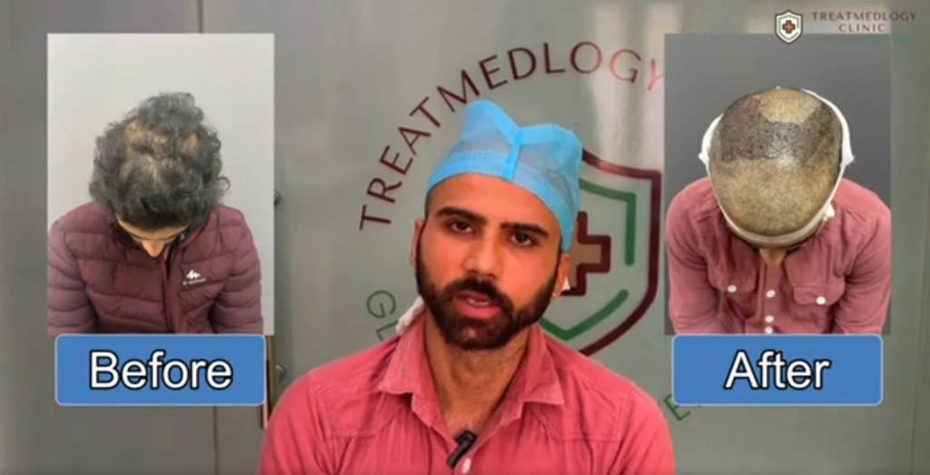 Navigating the Path to Safe Hair Transplants: Essential Tips for Success