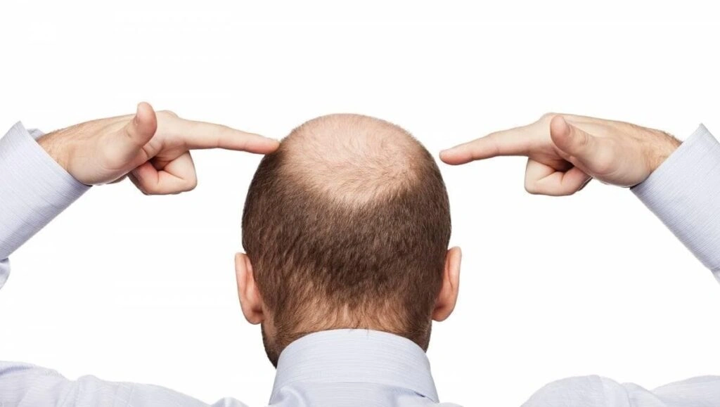Why Choosing the Right Hair Transplant Surgeon Matters: A Wake-Up Call for Cost-Conscious Patients in India