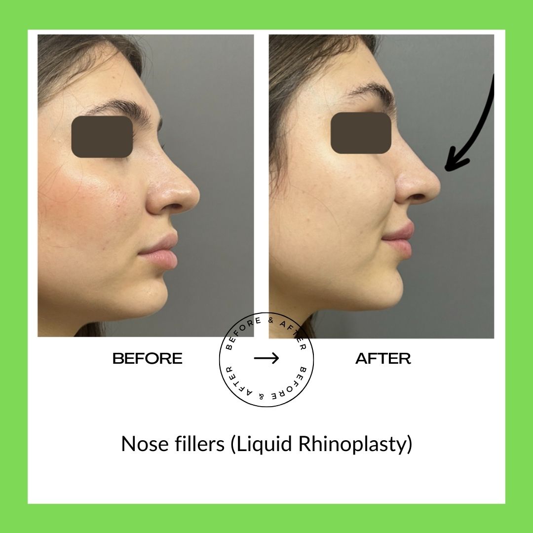 Nose fillers (Liquid Rhinoplasty)