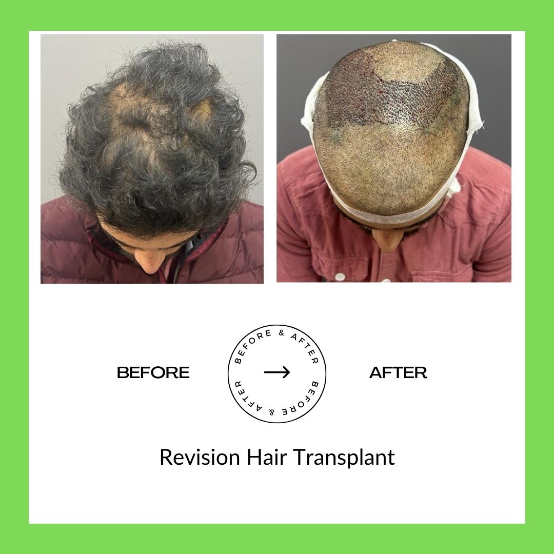 Hair Trasplant Surgery