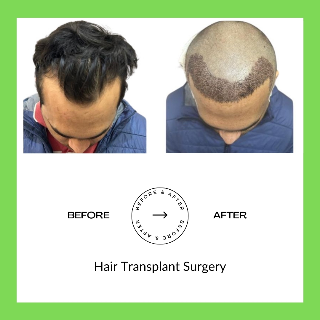 Hair Trasplant Surgery